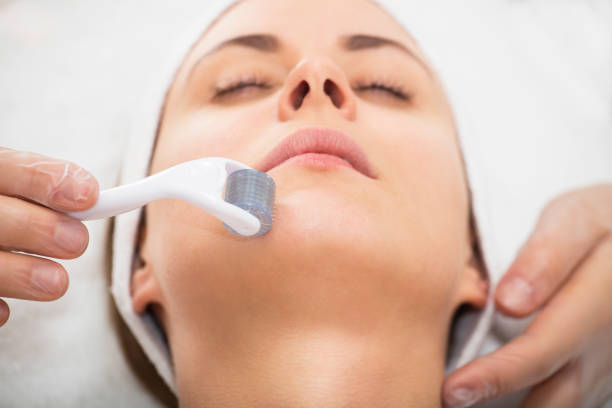 Woman receiving microneedling treatment at a spa.