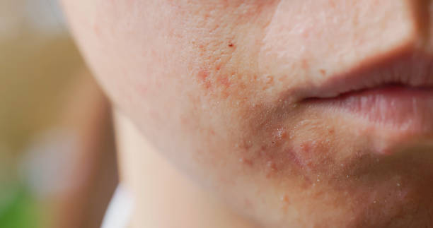 Close-up of a person's lower face showing acne on skin