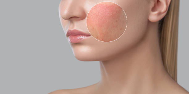 Close-up of a woman's face highlighting rosacea symptoms on the cheek